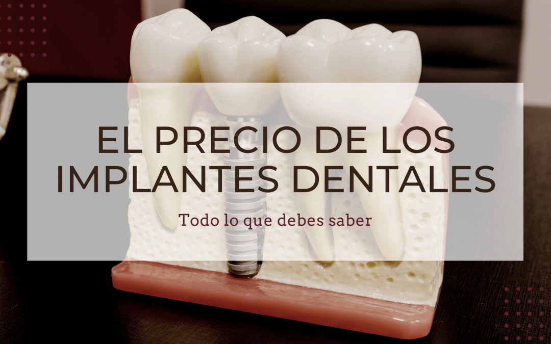 ¿Cuánto cuesta un implante dental?