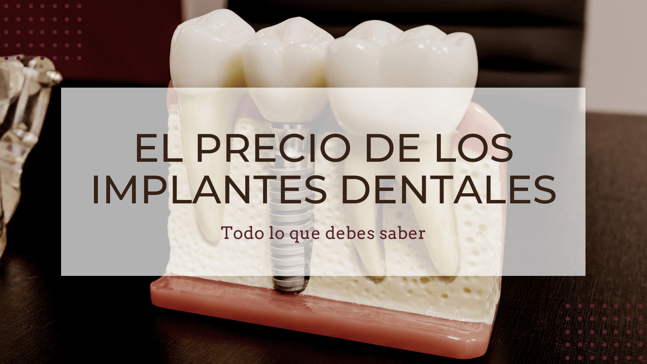 ¿Cuánto cuesta un implante dental? Clínica Dental Pérez Pastor